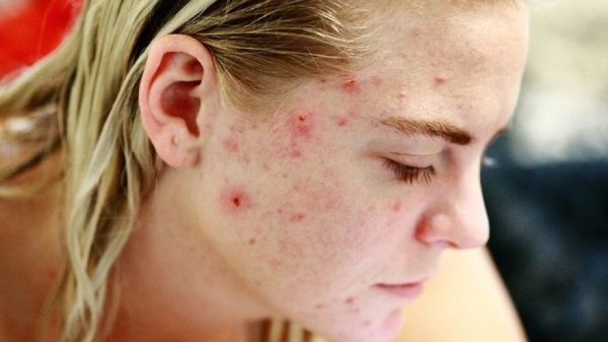 Cách đối phó với tình trạng da kích ứng, nổi mụn
